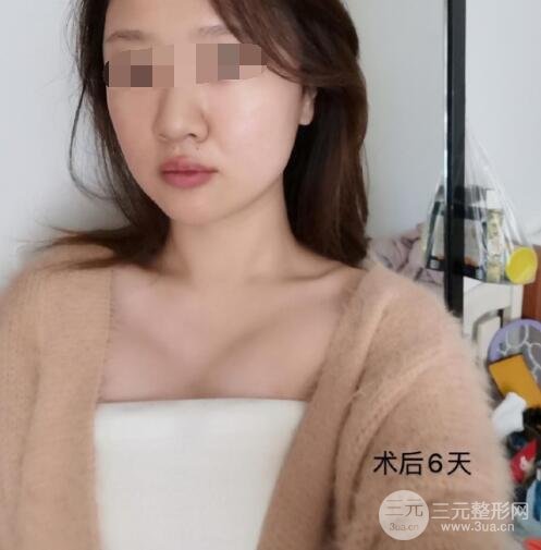 上海九院隆胸案例术后6天