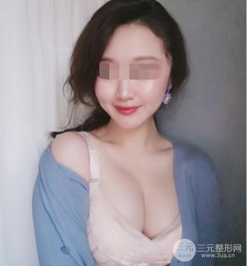 上海九院隆胸案例术后3个月