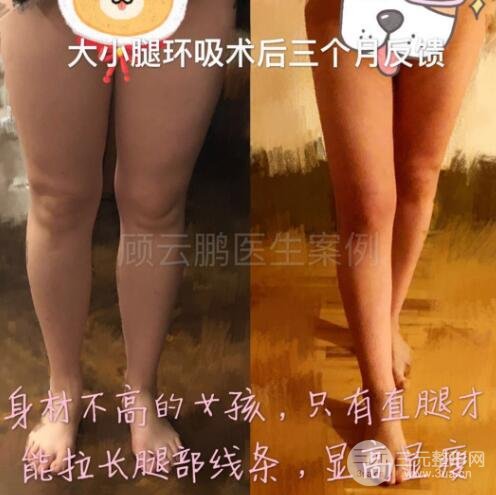 吸脂改变腿型