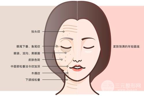 中面部除皱术