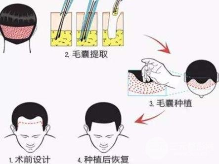 植发可以维持多久呢要多少钱一般