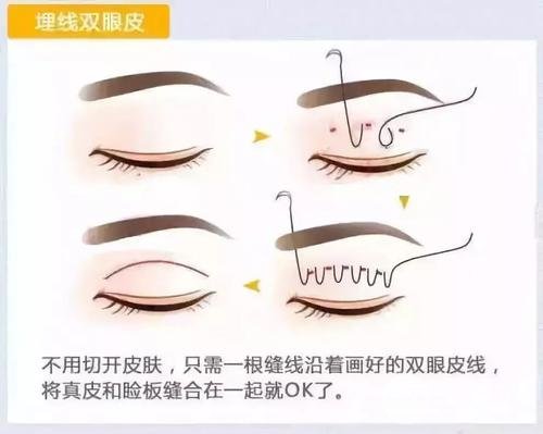 上海九院双眼皮哪个医生比较好?苏薇洁医生|双眼皮案例+科普