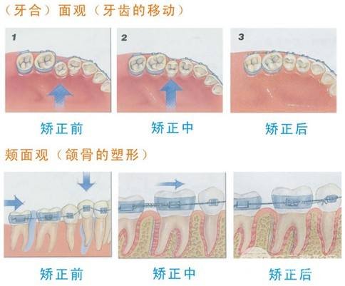 龅牙如何矫正