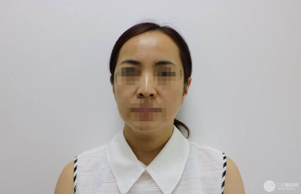 沈阳杏林做拉皮手术怎么样?拉皮手术案例+科普