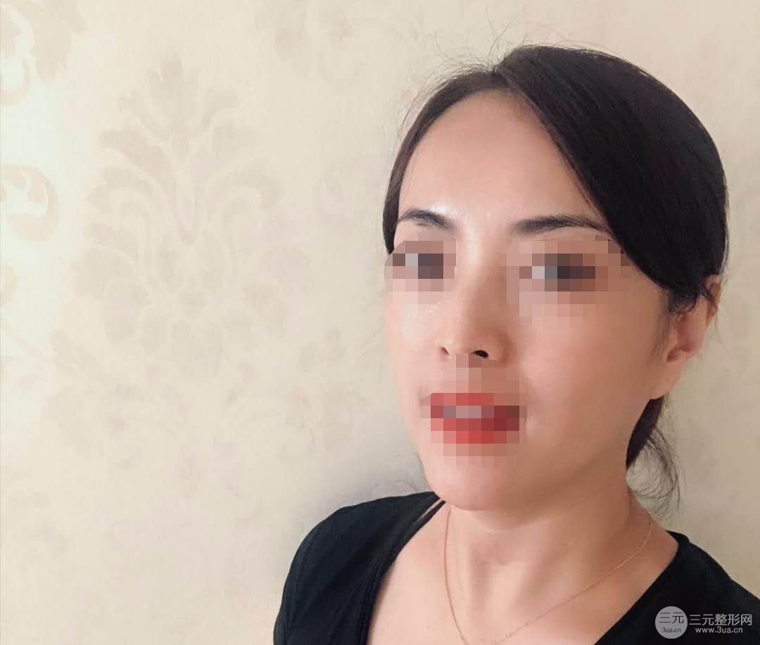 沈阳杏林做拉皮手术怎么样?拉皮手术案例+科普