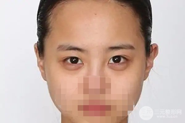 常州第一人民医院美容科割眼袋好吗?附祛眼袋案例
