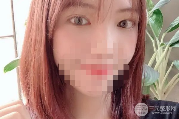 常州第一人民医院美容科割眼袋好吗?附祛眼袋案例