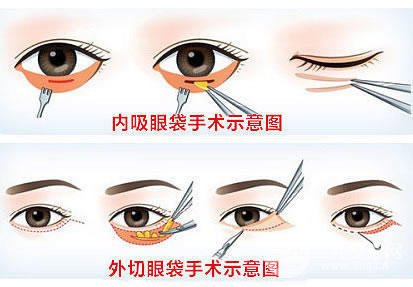常州第一人民医院美容科割眼袋好吗?附祛眼袋案例