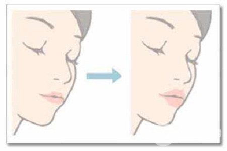 注射玻尿酸丰唇需要几支