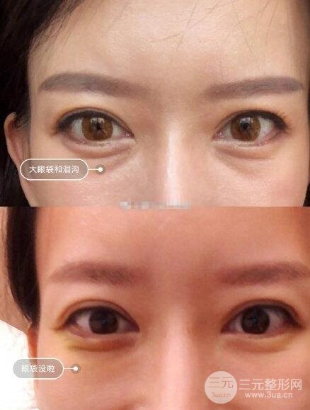 去眼袋果图