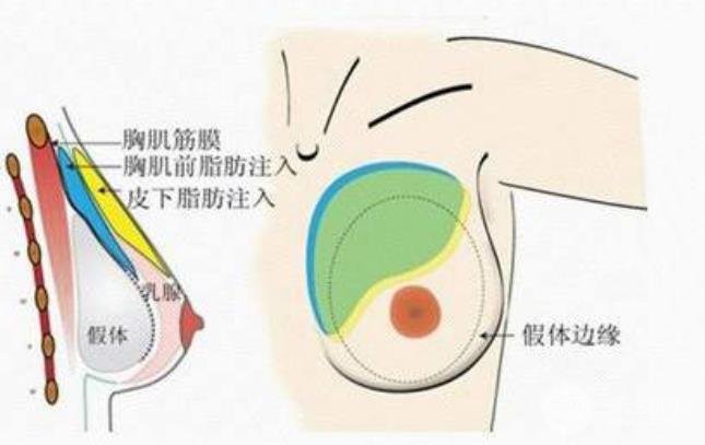 麦格丰胸假体在人体能存多久?