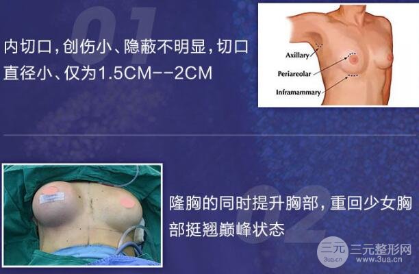 假体硅胶隆胸手术优点