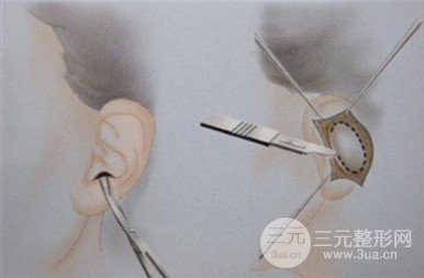 自体耳软骨隆鼻危害有哪些?