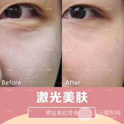 激光嫩肤美白果