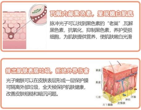 激光嫩肤美白原理