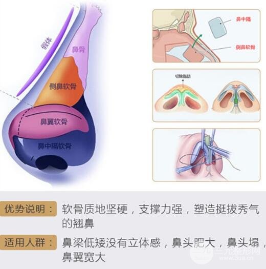 软骨隆鼻降低风险吗