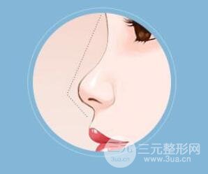 朝天鼻整形价格的影响因素