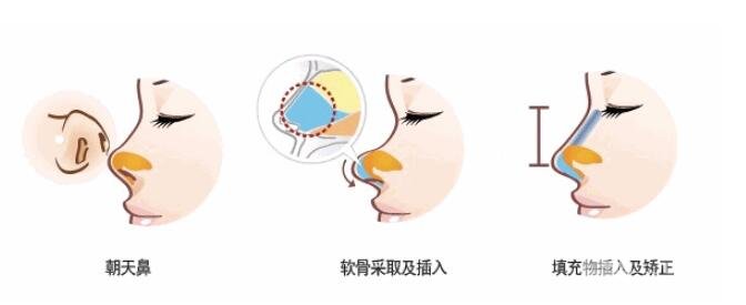 朝天鼻整形的术前准备