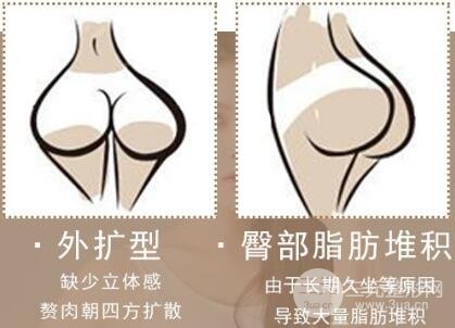吸脂瘦臀手术