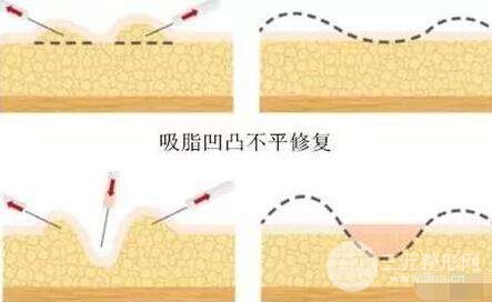 吸脂瘦臀危险吗