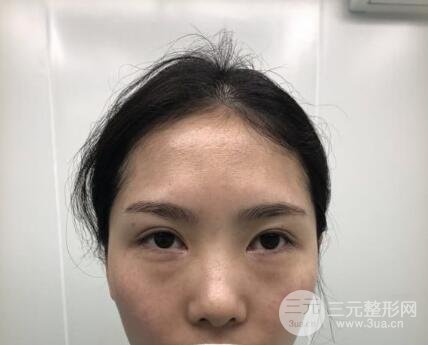去眼袋对比图