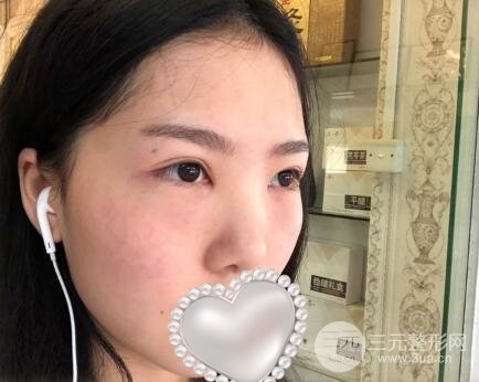 去眼袋术后
