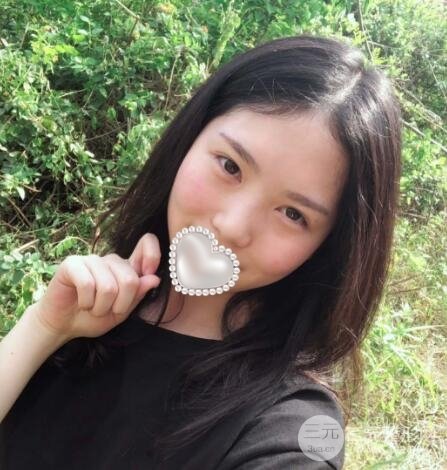 微创去眼袋术后对比图
