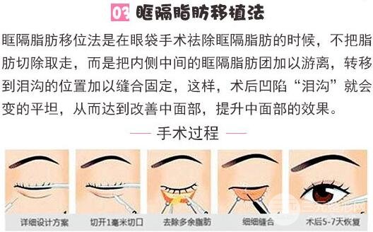 修复手术