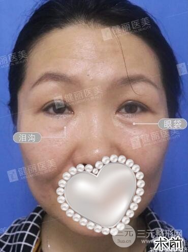 修复眼袋果图