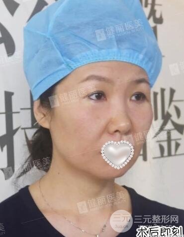 修复眼袋果图