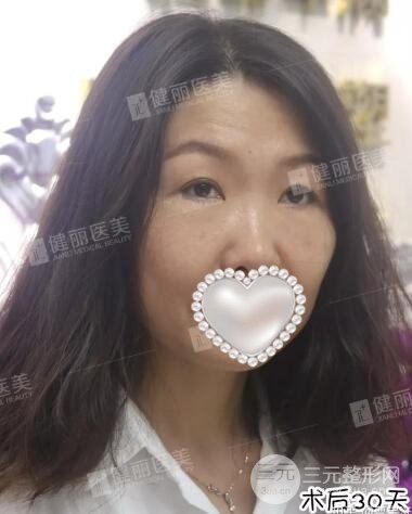 修复眼袋30天后