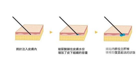 透明质酸丰额头