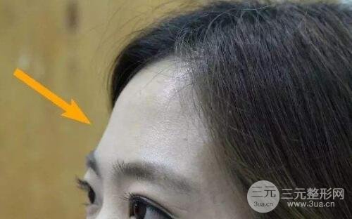 额头填充适合人群