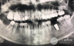 收藏徐州口腔医院种植牙价格表及过程记录