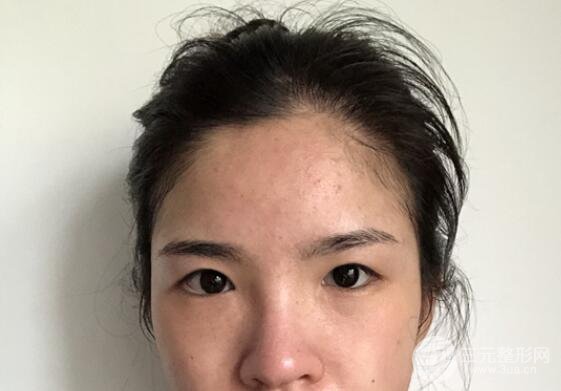 南昌大学一附院美容科案例术前