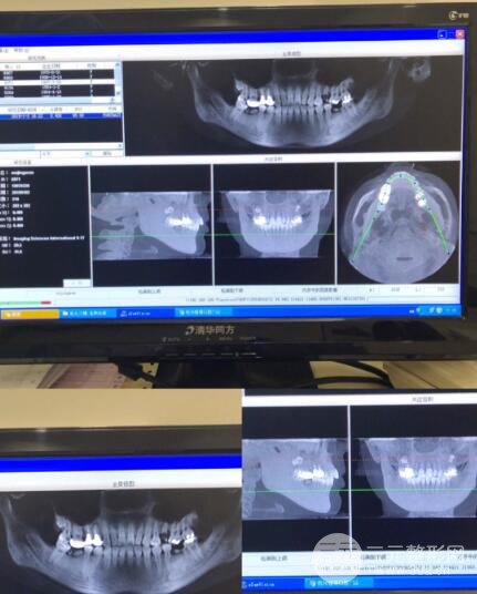 真人做烤瓷牙案例