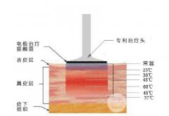 电波拉皮除皱价钱多少？这篇说的很清楚~