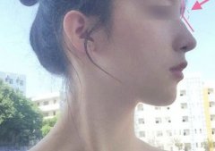 驼峰鼻矫正的缓解费用高么？几种手术方案分析