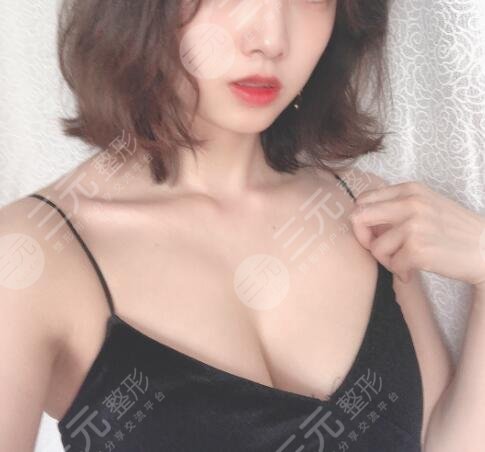 假体隆胸术后17天
