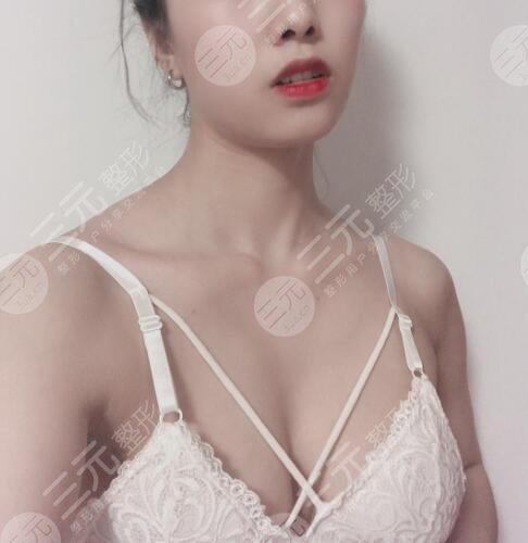 假体隆胸术后40天