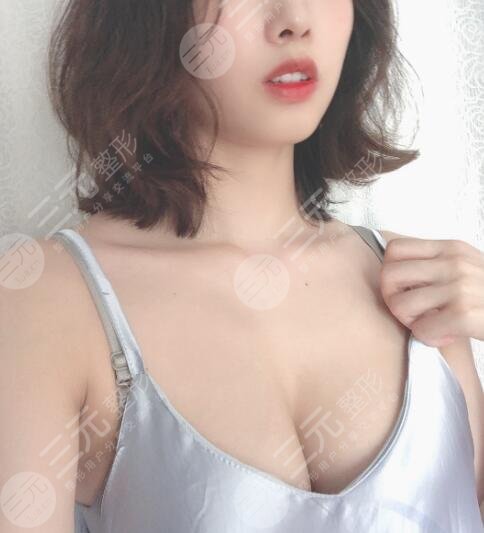 假体隆胸术后60天