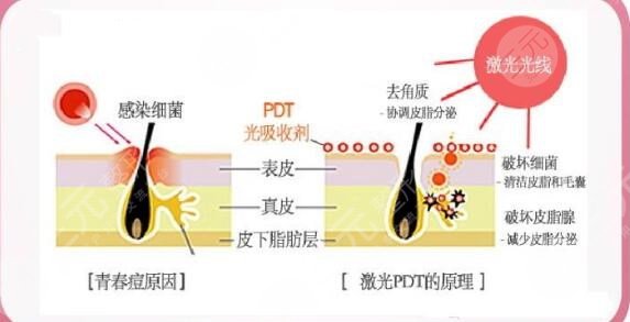 激光祛痘价格