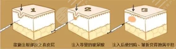 玻尿酸除皱注意事项