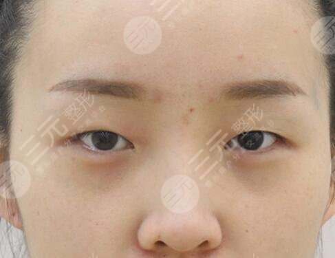 眼部整形手术反馈术前