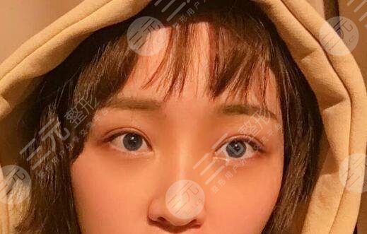 眼部整形手术反馈术后