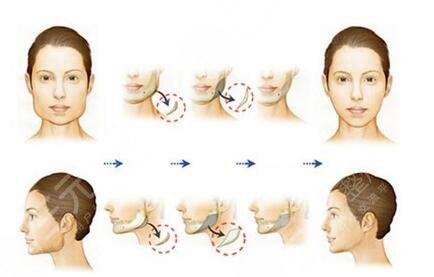 磨骨怎样变瓜子脸