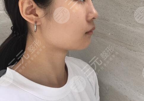 玻尿酸丰下巴案例前