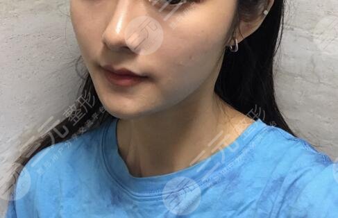 玻尿酸丰下巴案例后