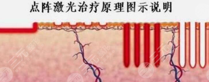 祛疤费用多少呢?影响收费的主要因素有四个: