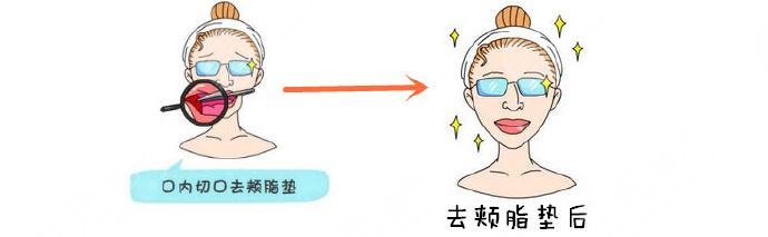 去颊脂垫后的注意事项